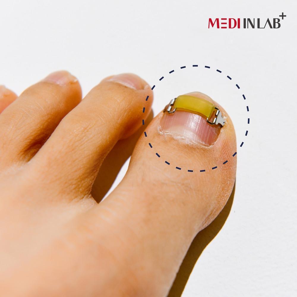 메디인랩 내성발톱 교정기 파고드는 발톱 교정 자가치료 테이프 와이어