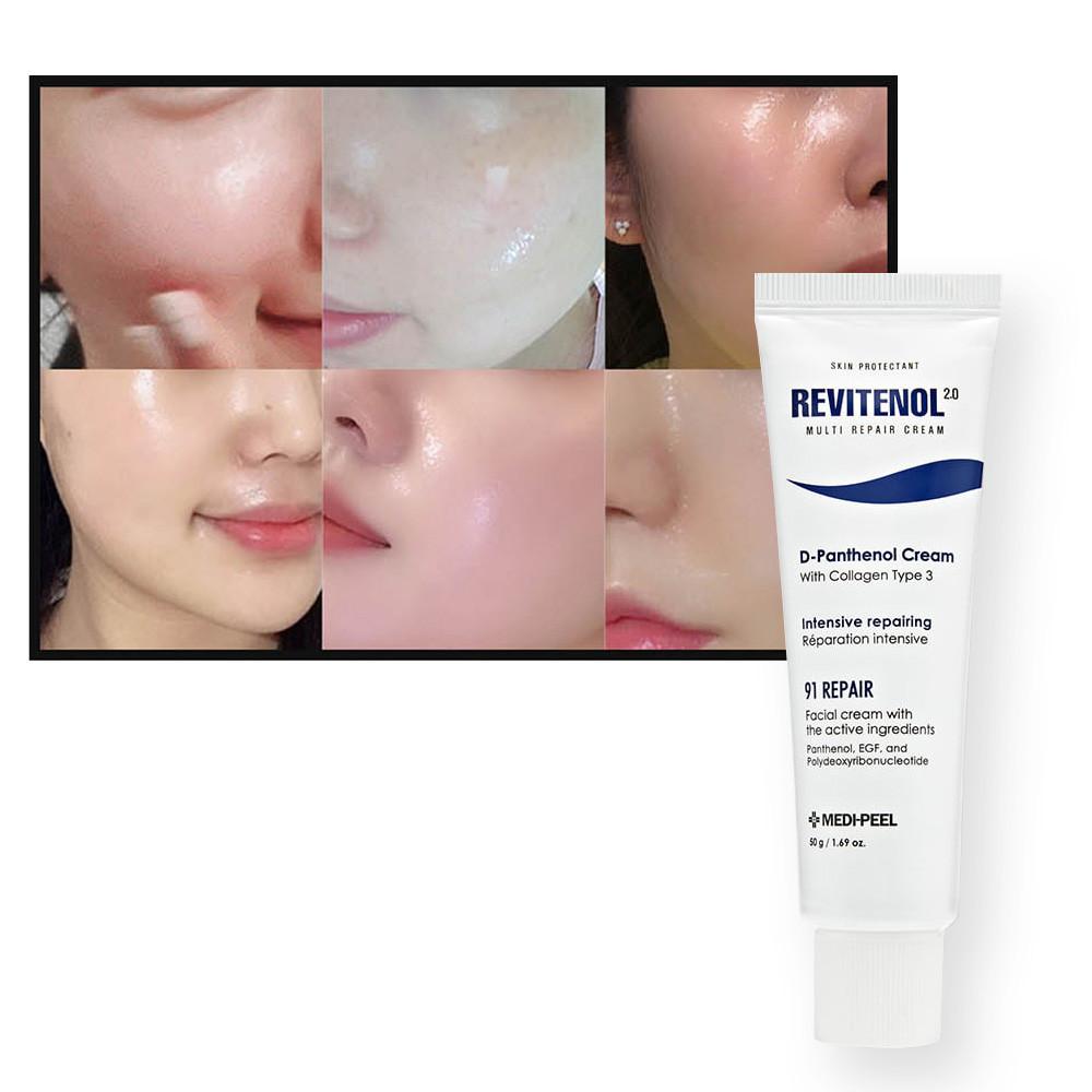 egf 피부과 레이저 점뺀후 이지에프 새살연고 레티놀 덱스판테놀 피부과 재생크림 50g