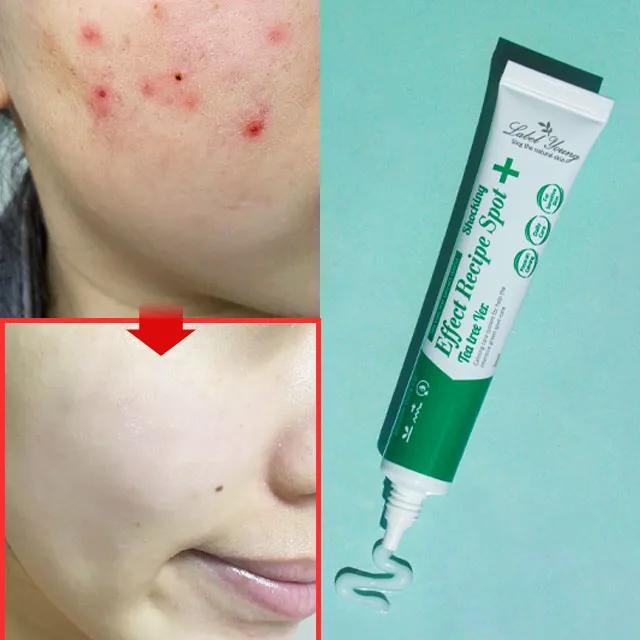 [문제성피부+피부결점+피부진정] 집중케어 쇼킹스팟티트리버전